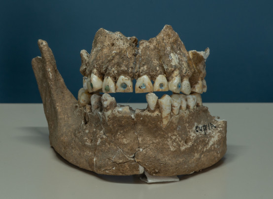 Incrustación dentarías, funciones esteticas identitoria tallando los dientes.