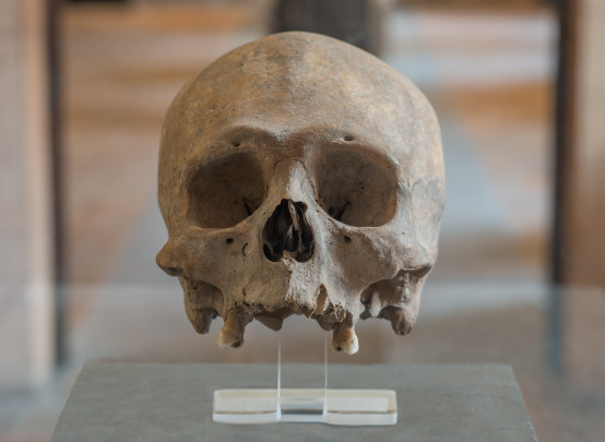 Cráneo humano con deformación